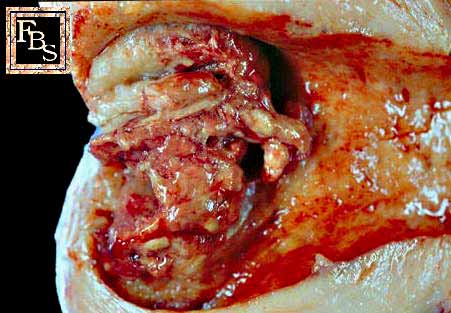 clear cell adenocarcinoma2.jpg